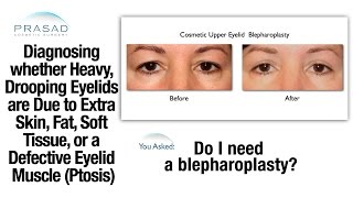 Diagnosing if Heavy Upper Eyelids are Caused by Extra Skin and Fat or Ptosis [upl. by Allen492]