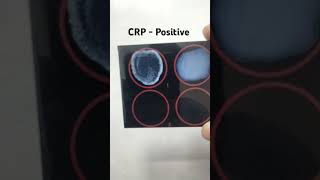 CRP test procedure  CReactive Protein  crp test kaise kiya jata hai  medical pathology [upl. by Salta888]