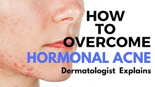 Skin Care Tips Treating HORMONAL ACNE [upl. by Yelak70]