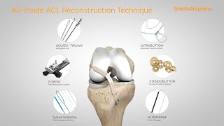 Allinside ACL Reconstruction Animation [upl. by Ahseela]