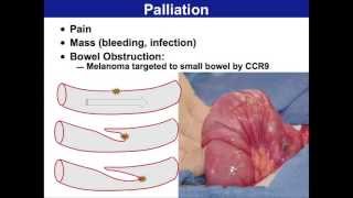 Surgery for Malignant Melanoma  Melanoma Education Symposium Mark Faries MD [upl. by Sand]