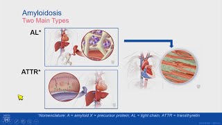 Treatment Update Medications for Cardiac Amyloidosis [upl. by Nosac]