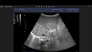 Portal vein chronic thrombosis with cavernous transformation [upl. by Dareen836]