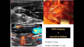 Thoracic duct end obstruction  By Claude Franceschi [upl. by Stephania9]