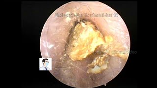 Ear wax removal Treatment of cerumen embolism [upl. by Animrac627]