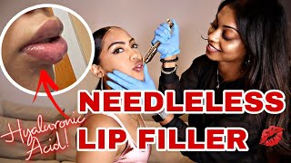 NEEDLELESS LIP FILLERS💋 [upl. by Divadnhoj]