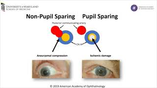 Cranial Nerve III Palsy [upl. by Vange]