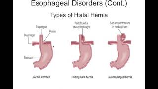 Chapter 36 Gastrointestinal Disorders BIOL300 [upl. by Arek681]