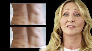 Freezing Fat Cells  CoolSculpting Removes Fat Without Surgery [upl. by Towney]