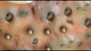 20 Biggest blackheads removed by pinching and squeezing by an expert [upl. by Nagear931]