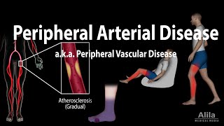 Peripheral artery disease Pathophysiology Causes Symptoms Diagnosis and Treatments Animation [upl. by Traci394]