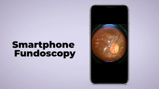 Smartphone Fundoscopy turn any smartphone into fundus camera [upl. by Ev]