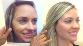 Botox amp Restylane Before amp After [upl. by Towroy]