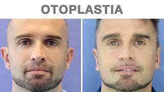 Otoplastia antes y después  Testimonio de David [upl. by Eidob]