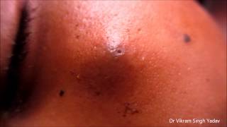 Big Infected Sebaceous Cyst Face [upl. by Quartus]