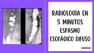 Radiología en 5 minutos Espasmo Esofágico Difuso [upl. by Annam]