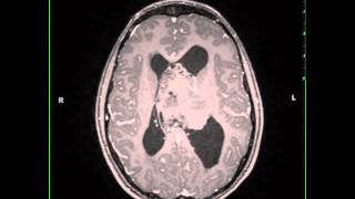 Atypical Neurocytoma [upl. by Brandenburg]