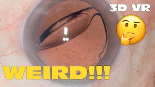 3D Phaco Clip 180  Weirdly Dislocated IOL VR Headset Version [upl. by Thurnau]