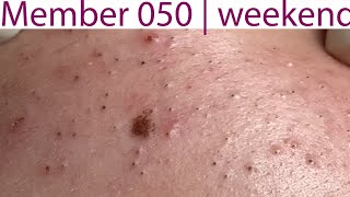 Acne Treatment Huong Da Nang 050  weekend  2023 [upl. by Fries]