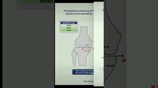 Preoperative planning or a double level osteotomy httpsyoutubedB0EzCpZ2LQsiwjszmeT3glUiQ73 [upl. by Grimbald]