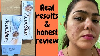 Acnestar Gel amp Acnestar soap Review amp results HOW TO GET RID OF ACNE FAST Pimples blackheads [upl. by Une211]