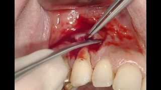 Tratamiento Periodontal Con Straumann Emdogain Efecto de Recesion [upl. by Ricker967]