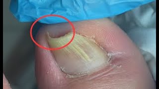 Satisfying ingrown toenail treatment [upl. by Aicnelev]