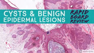 Rapid Board Review Cysts amp Benign Epidermal Lesions Dermpath Dermatology Pathology [upl. by Vedette]