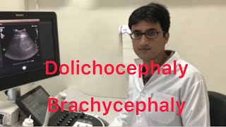 Sonography Dolichocephaly and Brachycephaly [upl. by Longwood]