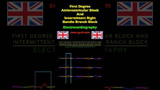 Electrocardiography  First Degree Atrioventricular Block And Intermittent Right Bundle Branch Block [upl. by Aerdnael]