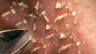 Best Satisfying Nose Plucking Blackheads Whiteheads Removal  Acne Treatment 22 [upl. by Fari146]