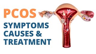 PCOS  Polycystic Ovary Syndrome Causes Symptoms amp Treatment [upl. by Zenitram]