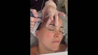 Microneedling the forehead to help reduce those lines and wrinkles microneedling forehead [upl. by Eerrehs300]