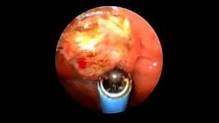 RIMOZIONE ENDOSCOPICA ADENOIDI CON RADIOFREQUENZE A RISONANZA QUANTICA MOLECOLARE [upl. by Gridley764]