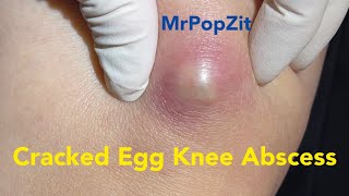 Cracked Egg Knee Abscess Large mass on knee under pressure and painful Pressure relieved [upl. by Eninotna236]