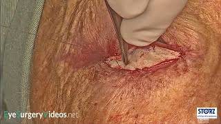 Lower lid cicatricial ectropion repair with full thickness skin graft [upl. by Sylvia579]