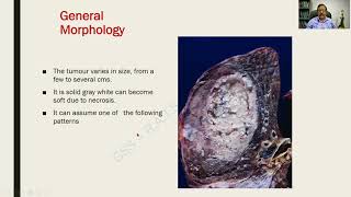 Bronchogenic Carcinoma Part I  Respiratory Pathology  RATS [upl. by Dianemarie423]