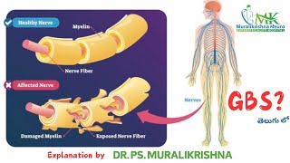 GuillainBarre Syndrome  GBS in Telugu  DrPSMuralikrishna  Nerves  neurologist [upl. by Ennayar948]