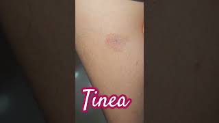 Tinea Infection imwell tinea [upl. by Monique]