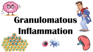 Granulomatous Inflammation  Types Pathophysiology Different Cell Types In Granuloma amp Examples [upl. by Naamann]