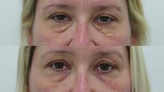 Xanthelasma removal treatment demo and results  see beforeafter photos [upl. by Anyela]