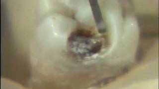 Removal of Carious Lesion [upl. by Rumit495]