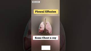 Pleural Effusion amp Chest Xrays [upl. by Ardnac584]