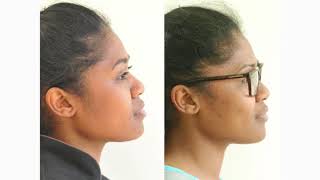 How Orthodontic Extractions can change Facial Profiles [upl. by Acinej]