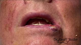 How well can lip lesions heal [upl. by Russ]