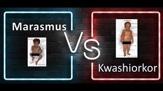 Pediatrics Difference between marasmus and Kwashiorkor PEM Protein energy malnutrition Age Growth [upl. by Auof]