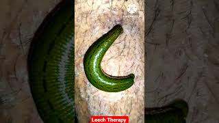 Leech Therapy shortshairfallpsoriasisayurveda [upl. by Nemzzaj]