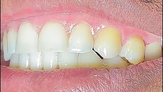 Dental Crown Cementation Procedure turn on the subtitles GreatTeeth [upl. by Lidstone489]