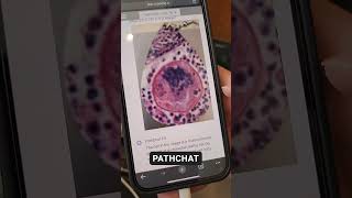 How do you test pathology AI with earrings [upl. by Anyk]