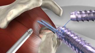 Knotless Rotator Cuff Repair with Arthrex® SpeedFix™ [upl. by Hyo807]